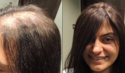Before and After