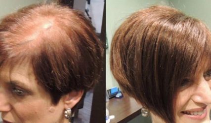 Before and After