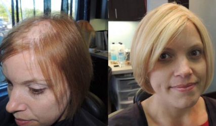 Before and After