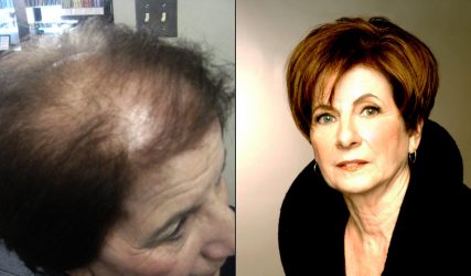 Before and After