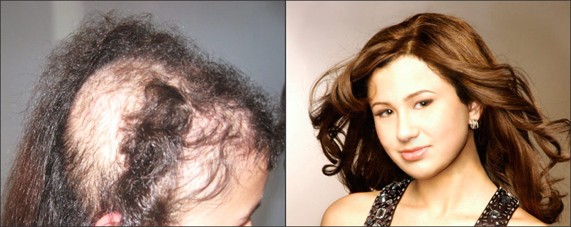 Hair loss solutions
